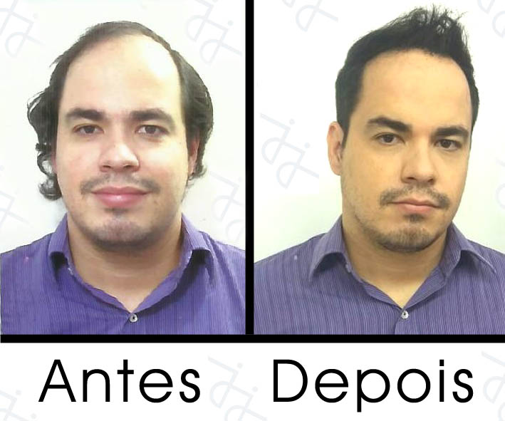 antes e depois calvice jj cabeleireiros